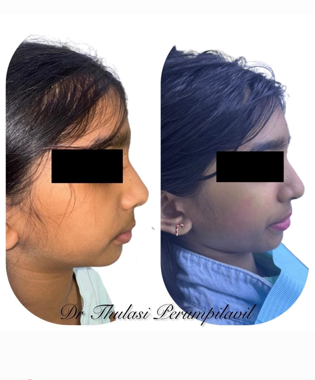 Myofunctional cases – 02