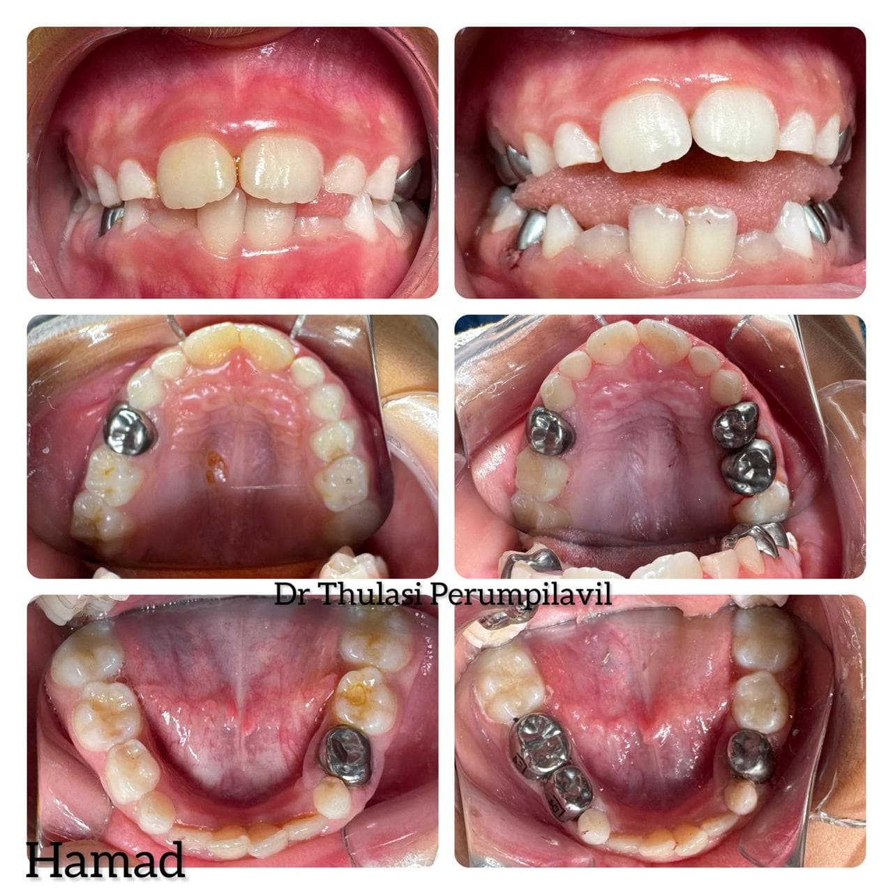 Full mouth rehabilitation