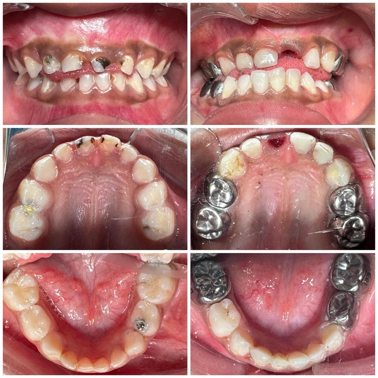 Full mouth rehabilitation – 02