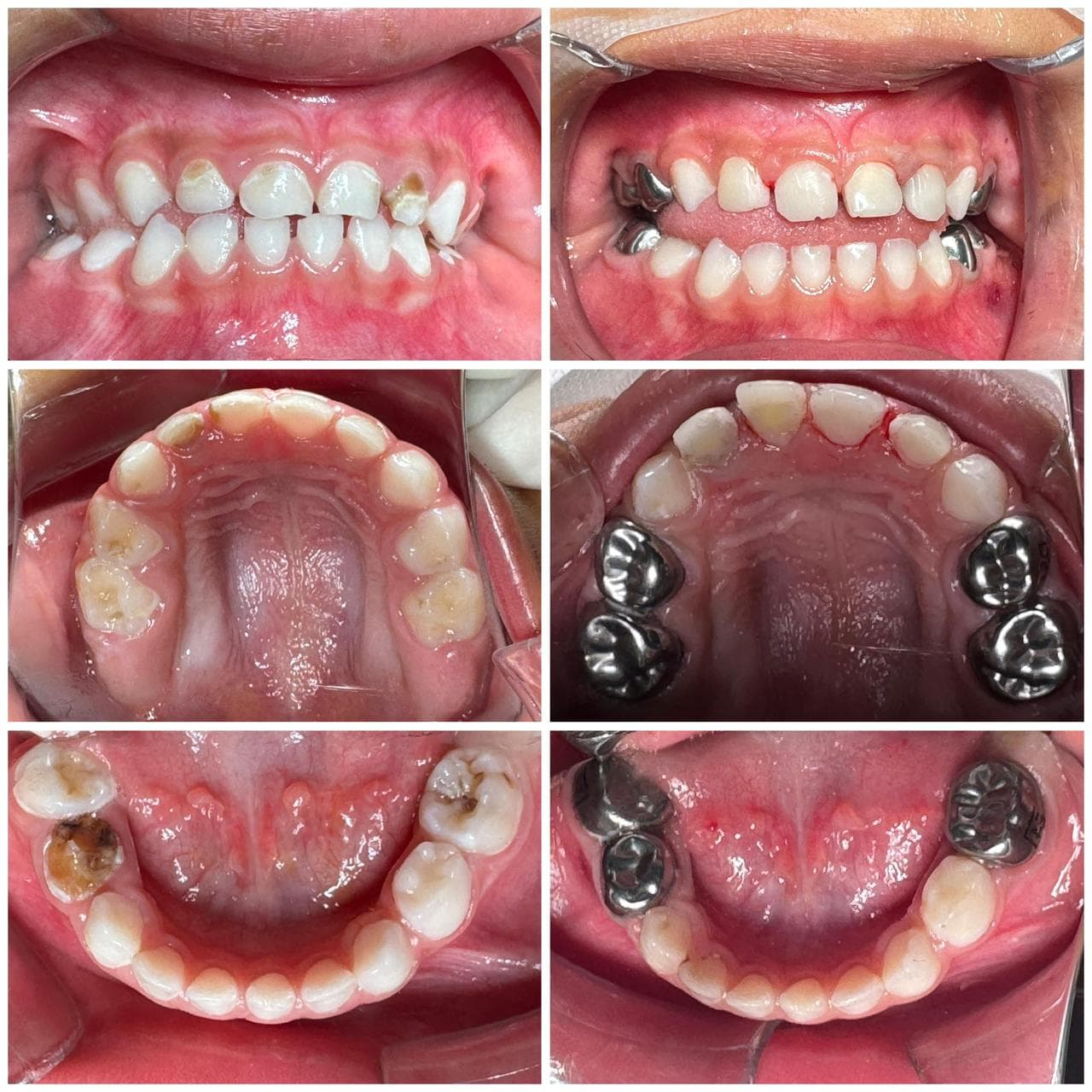 Full mouth rehabilitation – 03