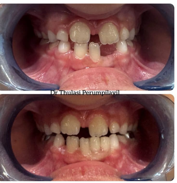 Space maintainers – 02