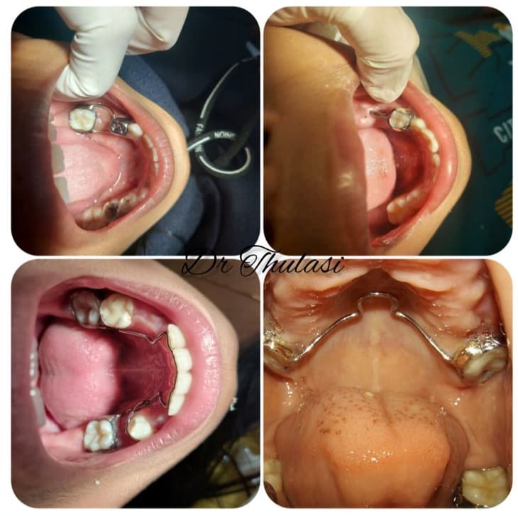 Space maintainers – 03