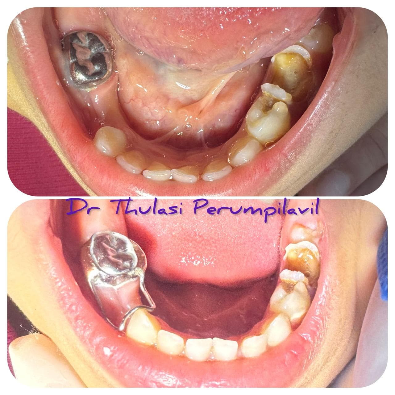 Space maintainers – 04